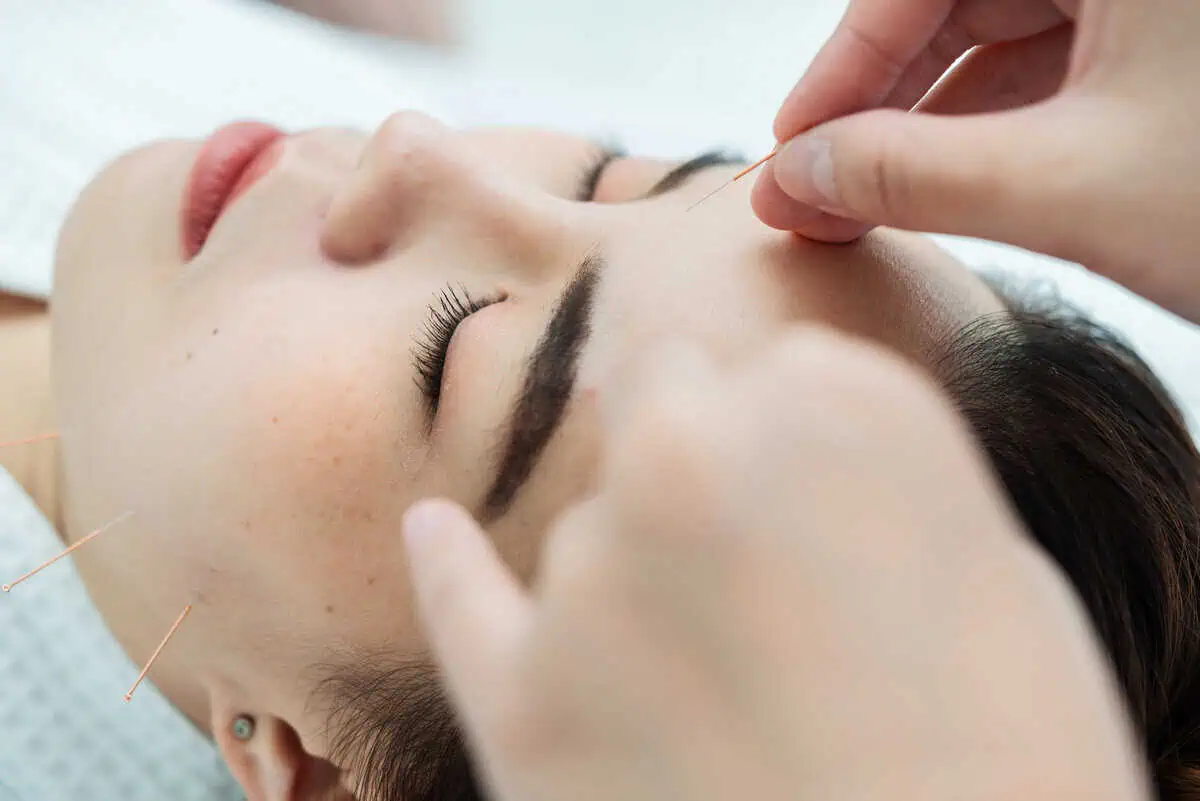 Facial acupuncture